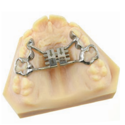 Expansor de Palato CAD-CAM