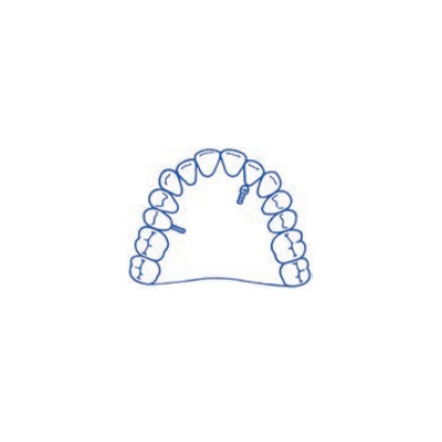 Parafuso de Um Dente com...