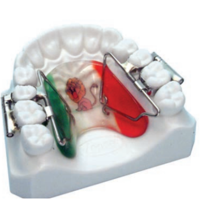 Distalizador Molar Rápido